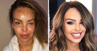 Katie Piper è sopravvissuta a un’aggressione con l’acido da parte del suo ex ed è rinata come una fenice dalle ceneri