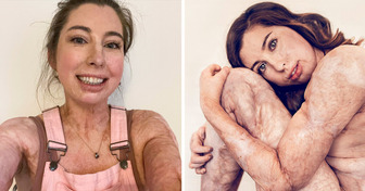 La storia di una donna che è sopravvissuta a ustioni sul 96% del corpo e ha stravolto l’industria della bellezza