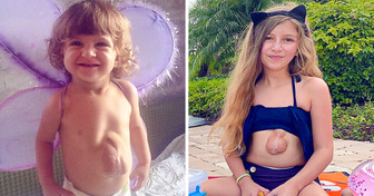 Ecco una bambina miracolosa nata con un cuore che le batte fuori dal petto