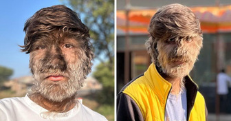 Il ragazzo che è cresciuto con l’appellativo di “scimmia” ha aperto un suo blog