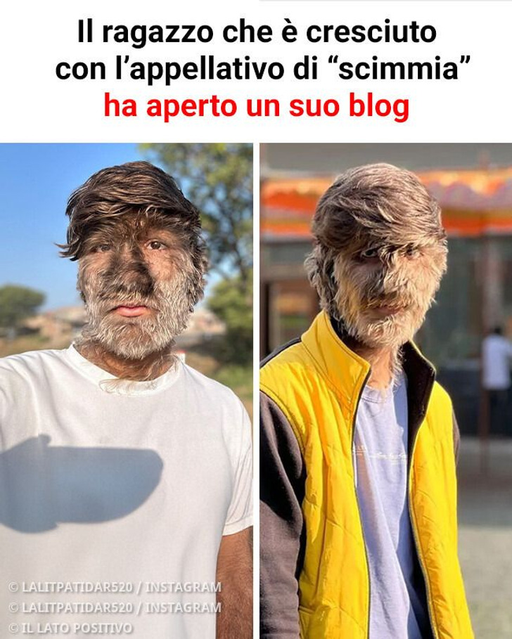 Il ragazzo che è cresciuto con l’appellativo di “scimmia” ha aperto un suo blog